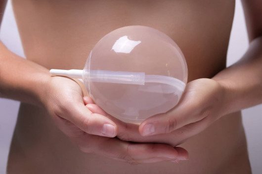 Gastric balloon