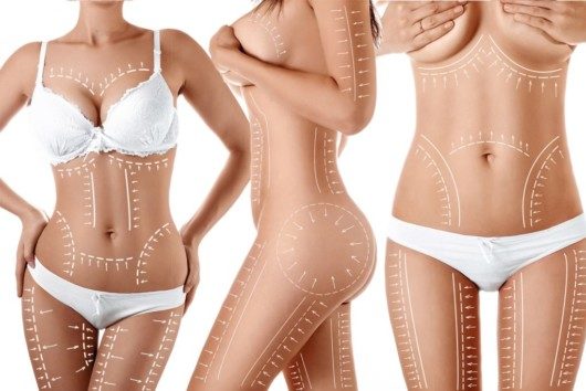 Close up bodies of three girls with marks on to show where the  liposuction is done