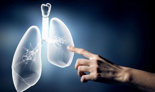 a patient with malignant pleural mesothelioma