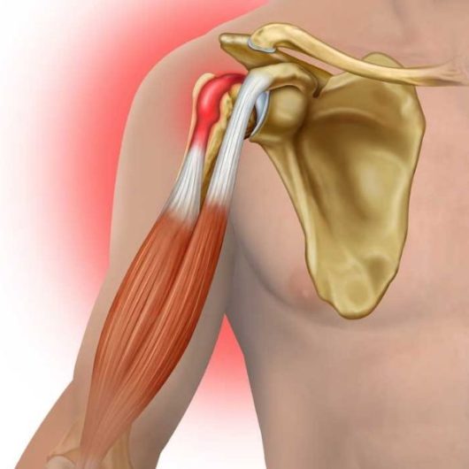 Bicep tendonitis is an inflammation around the tendons that connect the bicep muscles.