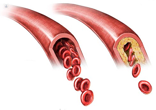One healthy artery and one unhealthy and blocked with cholesterol on white background