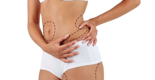 A girl on white background with marks on her body where the fat should be removed during liposuction