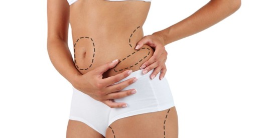 A girl on white background with marks on her body where the fat should be removed during liposuction