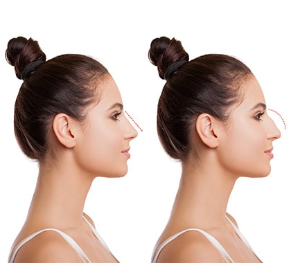 Before and after picture of the girl after a rhinoplasty 