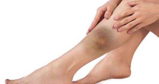 A woman with a huge bruise on her shin. She has a shin injury