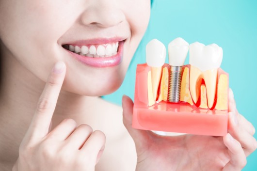 A girl with a nice smile and even teeth shows what an implant is. She is holding the implant sample and pointing at her tooth