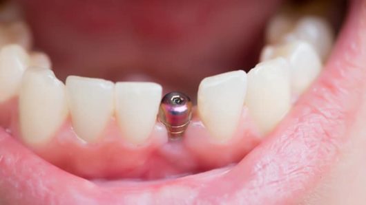 A mouth that shows a dental implant instead of a tooth