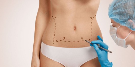 A doctor is marking the girl's places to be removed during the tummy tuck operation