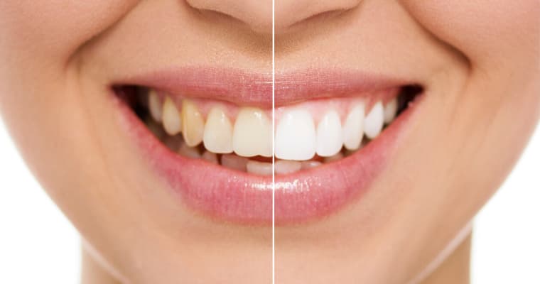 Girl showing before and after teeth whitening results