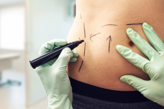 A doctor is marking the fat areas on the body before liposuction procedure