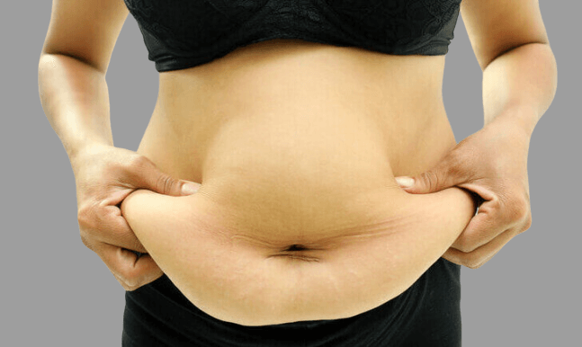 A woman with a significant amount of weight, big belly and loose skin within midsection