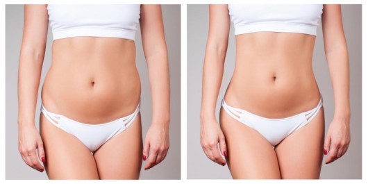 2 girls showing before and after abdominoplasty results  
