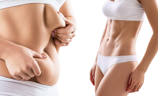 Before and after abdominoplasty pictures  