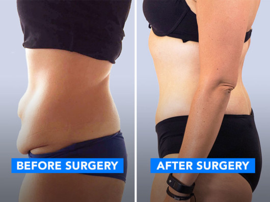 A woman showing her belly photo before and after tummy tuck surgery