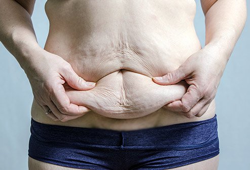 A woman holding her excess skin on the belly 