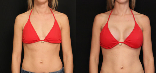 A girl in a red swim top shows before and after breast augmentation pictures