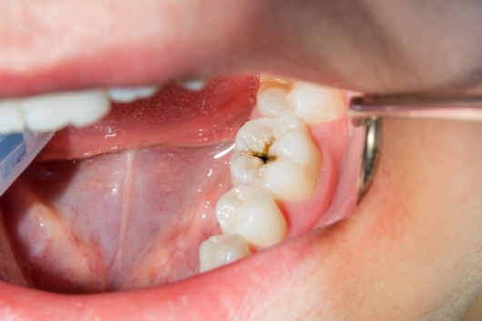 An open mouth with a cavity. Tooth decay problem. 