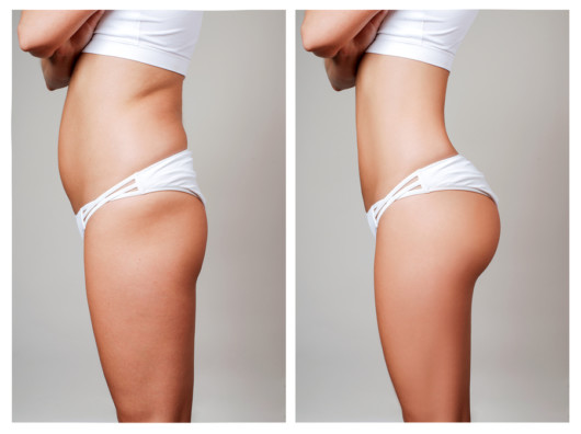 Female body before and after liposuction. Surgical fat transfer.