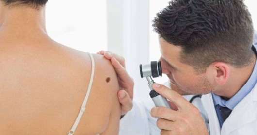 Doctor is checking a big freckle on girl's shoulder with a microscope