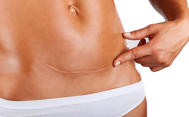 Girl showing her scar after tummy tuck procedure