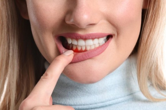 A beautiful woman pointing out at her teeth with gum disease 