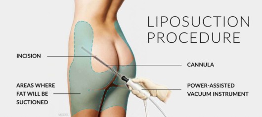 The doctor is showing how to do liposuction procedure a girl 