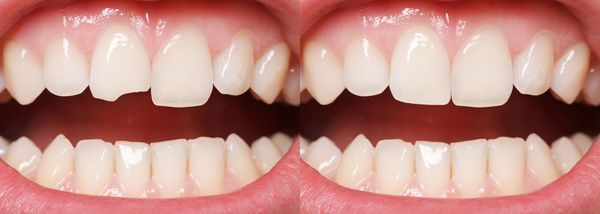 A mouth with before and after teeth bonding