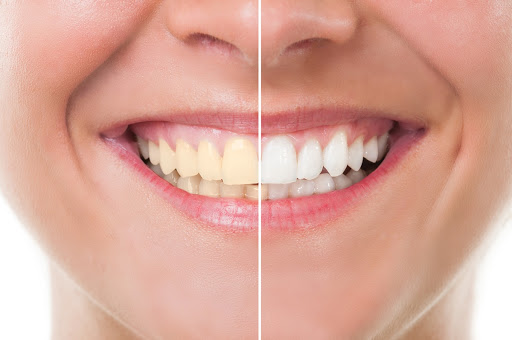 A woman smiles wide and shows her before and after teeth whitening 