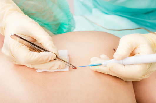 The doctor is removing cancerous freckle on the back with a laser