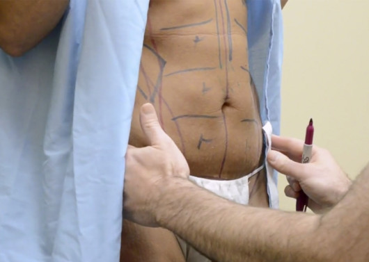 The woman with marks on her body before mommy makeover procedure 