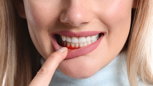 Girl shows her gum disease