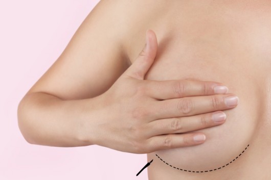 Close up picture of of girls breast with inframammary incision under the breast