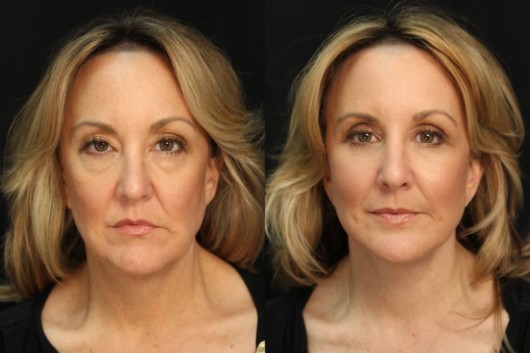 a middle age woman shows the results of before and after facelift operation