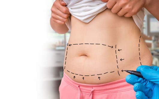 A close up girl's belly with marks on that the doctor put before liposuction procedure