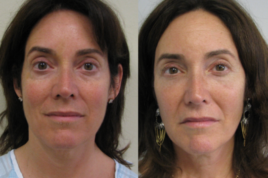 A close up women's face before and after facelift procedure