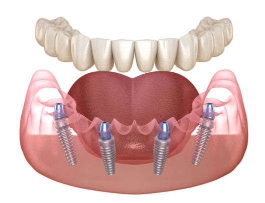 a 3d model of the teeth and posts in jaw on white displays how All-on-4 dental treatment works