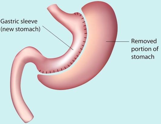 A picture that shows how gastric sleeve surgery is performed 