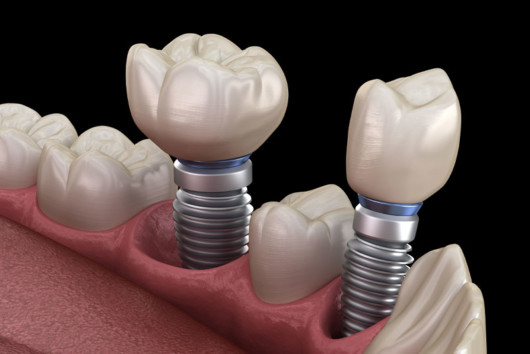 3d dental implants on black 