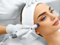 A doctor is doing Potenza™ Radiofrequency Microneedling to the girl