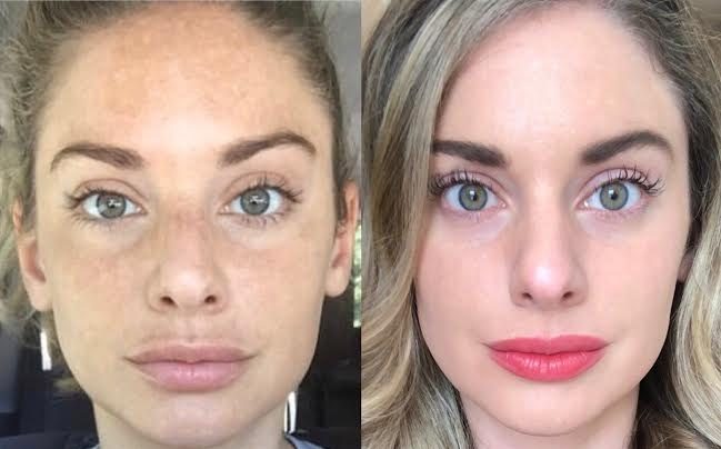 Before and after pictures of the girl's face after the RF Microneedling procedure 