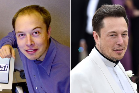 Elon Mask before and after hair transplantation