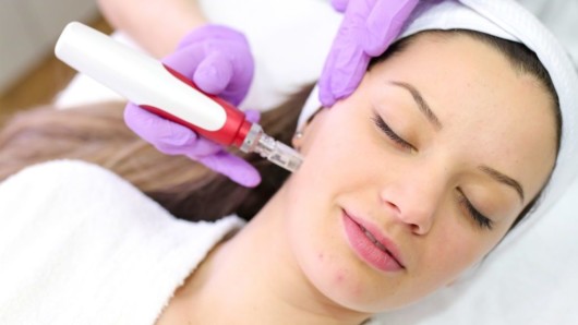 A girl is lying with her eyes closed and doing microneedling procedure