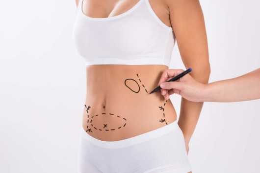 a close up picture of the girl's body where the doctor marks the problematic areas to remove during the mommy makeover