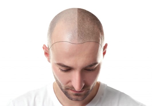 Bold man isolated on white showing his head before hair transplantation. One part of his head is bold and the other is with transplanted hair 