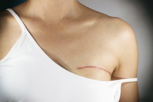 A close picture of the girls scar on her breast