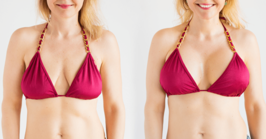 Breast augmentation before and after pictures of the girl in red bra isolated on white