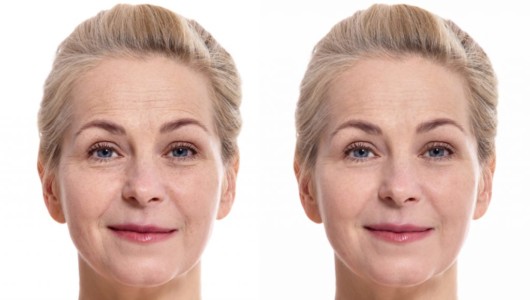 Before and after pictures of a woman after rejuvenation treatments