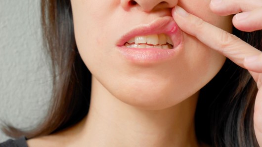 A girl has oral cancer on the lip