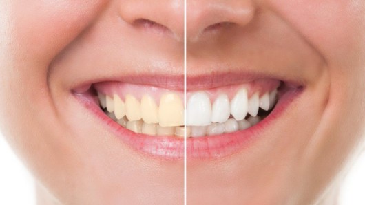 A close picture of the girl's mouth before and after teeth whitening