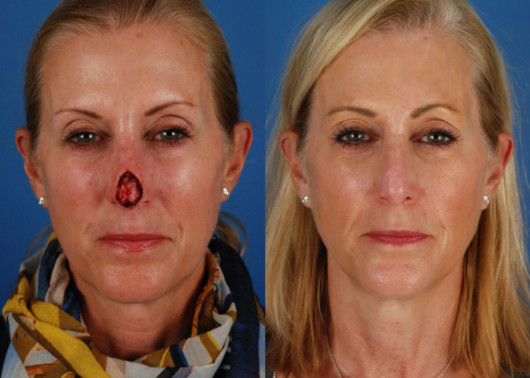 A close up face of the woman on blue before and after skin cancer reconstruction.